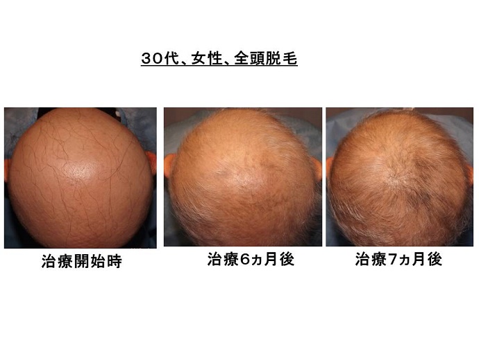 円形脱毛症　病院""